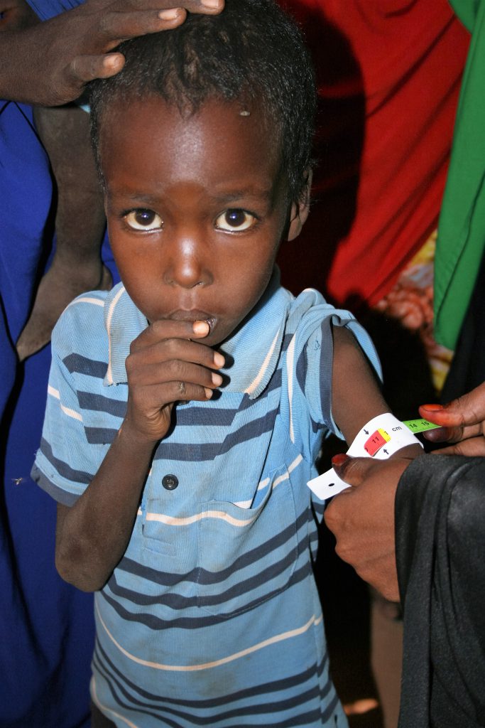 child arm measurement food crisis in Somalia
